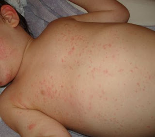 roseola rash pictures in children #11