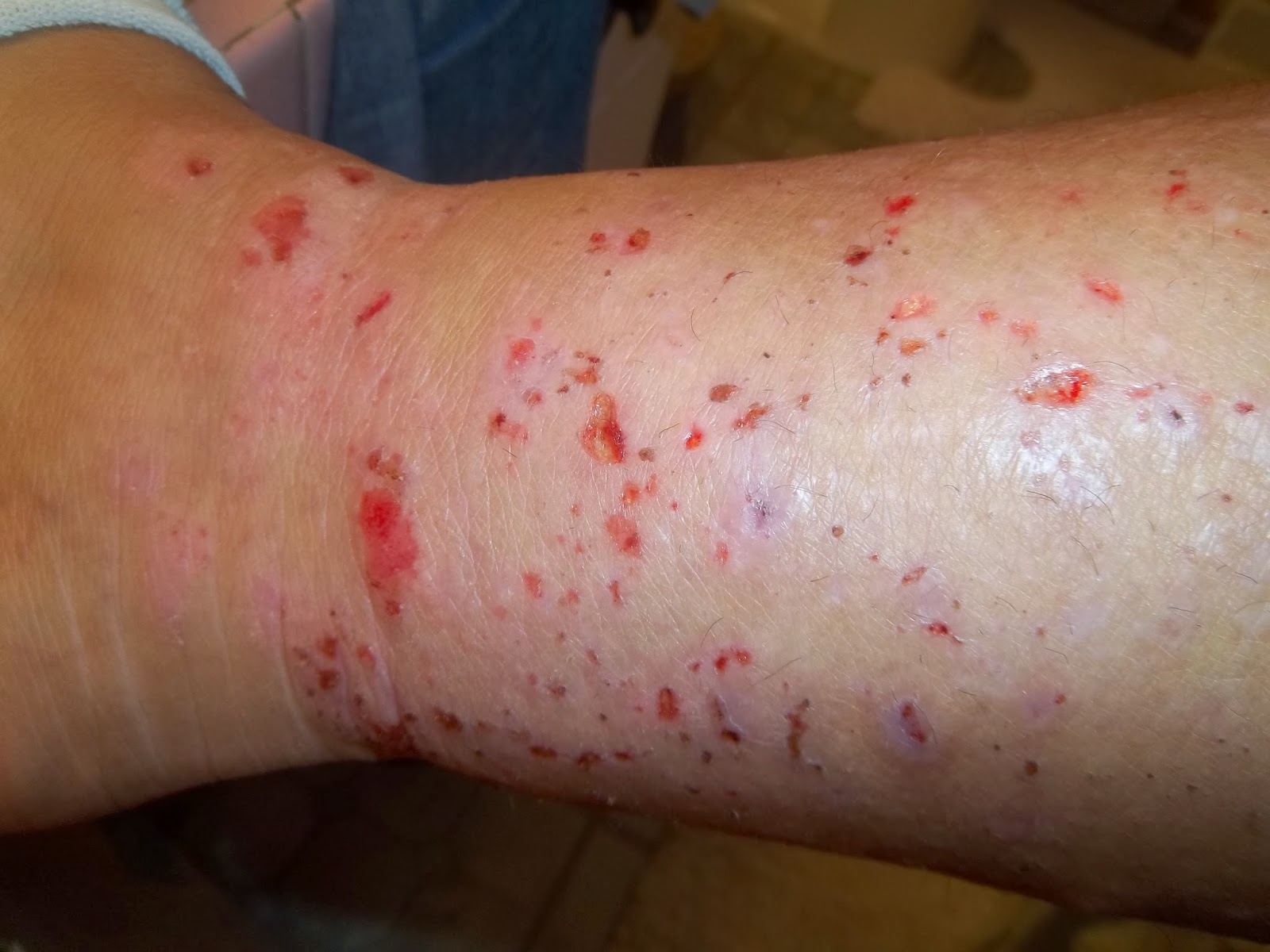 stopping-topical-steroids-pictures-of-recent-flare