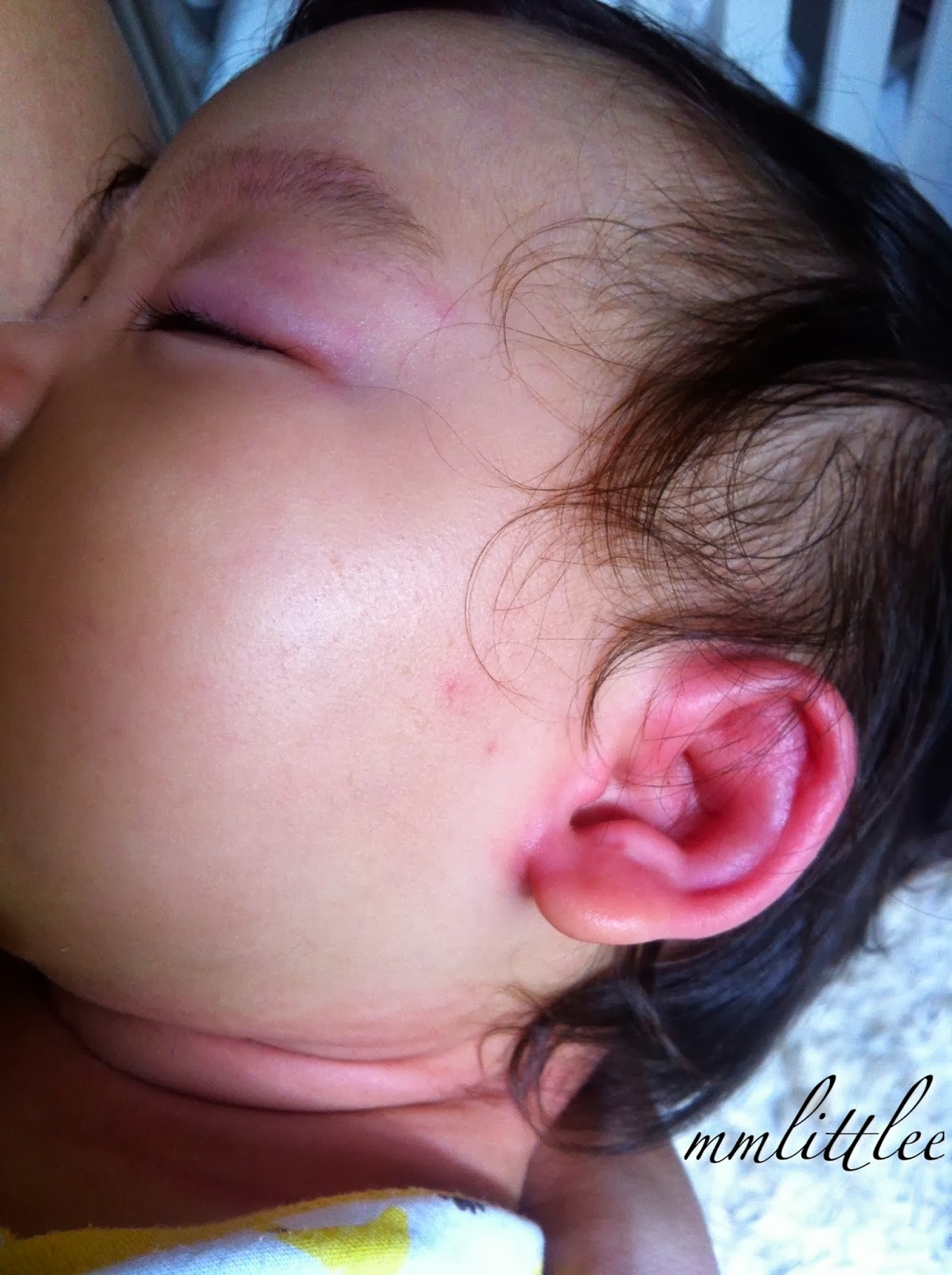 Ear swelling and facial hive, transfomers porn