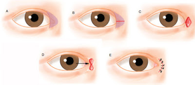 Eyelid Surgery by Prof Dr CN CHUA 蔡鐘能: Doc, Do I Need Operation on My ...