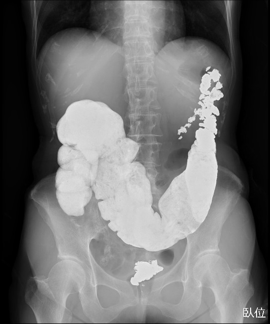 松下 Er ランチ カンファレンス 画像クイズ 胃バリウム検診の数日後の腹痛