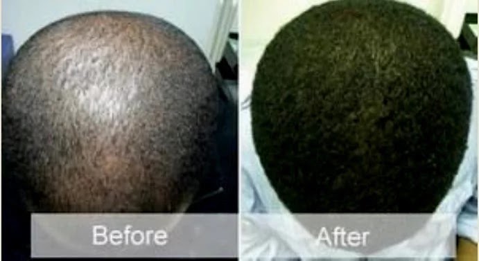 Best Way Regrow Your Bald Head Naturally In 3 Weeks Polypurpose