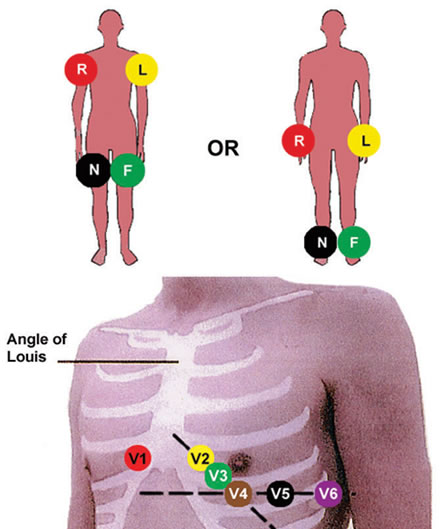 Ketahui Cara Pemasangan EKG 12 lead ekg limb diagram 
