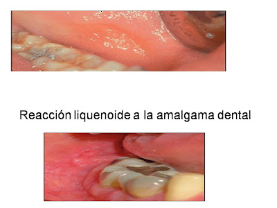 Reacción liquenoide a amalgama