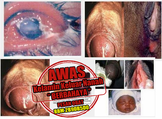 Obat Penyakit Kencing Bernanah Obat Penyakit Kencing Bernanah