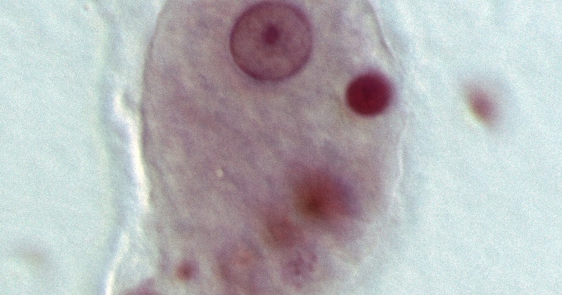 заболевания вызванные амебой