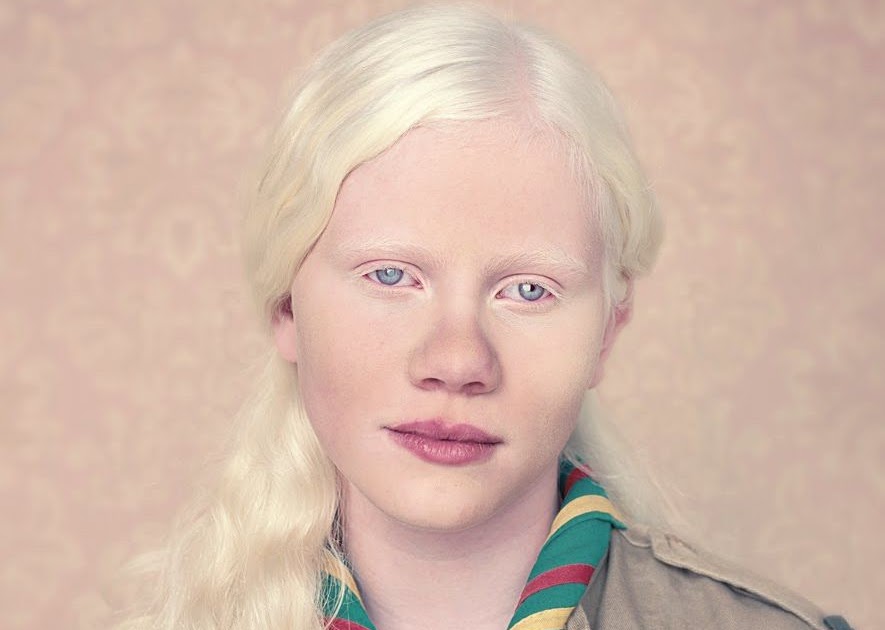 Альбинизмом страдают. Фенилкетонурия и альбинизм. Альбинизм глазной Форсиуса-Эрикссона. Альбинизм у монголоидной расы. Альбиносы люди.