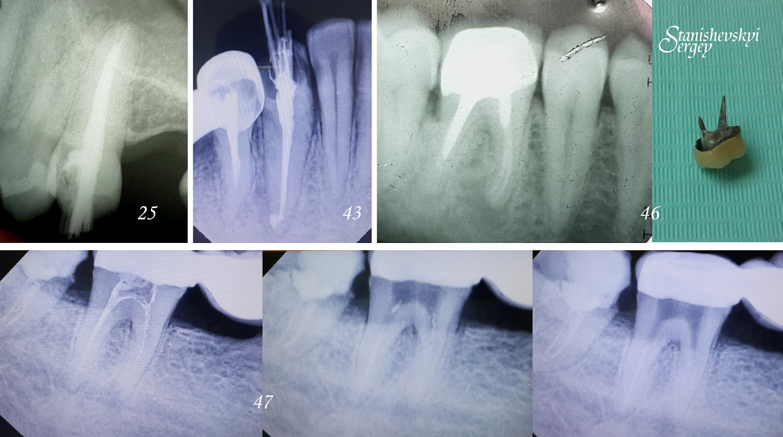 4 канальный пульпит зуба. после пломбирования каналов. стекловолоконный штифт с пломбой. выведение пломбировочного материала за апекс. пломбирование корневых каналов.