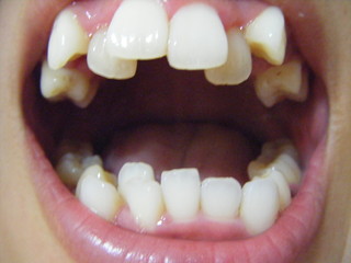 teeth tooth malaligned zig zag brush crooked decay criss cross misaligned india harder smiles franklin crowded makes them