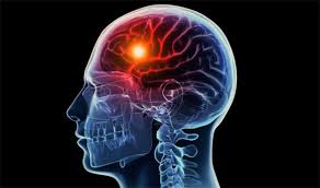 Stroke Ringan Apa Bisa Sembuh?, apa nama obat ampuh stroke berat?, Cara Terapi Stroke Ringan yang Alami