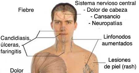 VIH: SÍNTOMAS TARDÍOS DE LA INFECCIÓN POR VIH/SIDA