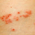 Are shingles contagious to kids, babies and newborns (infant)