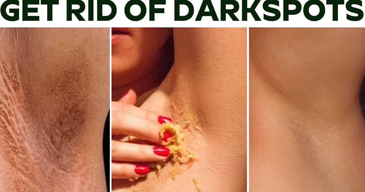 Get Rid Of Age Spots Naturally Get Rid Of Age Spots Naturally