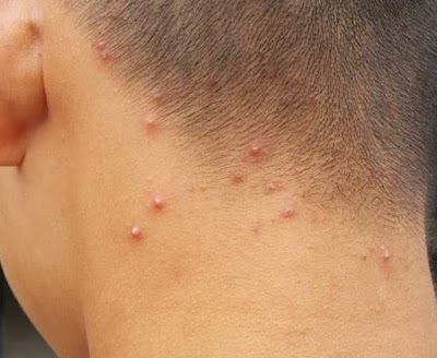 Acne On Hairline Neck