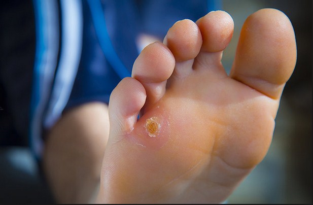 home remedies for corns on your feet