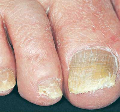Healthy Fingernails: Clues About Your Health Video - WebMD