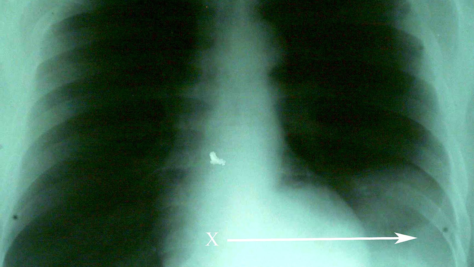 Diaphragmatic rupture Diaphragm Injury Injury Choices