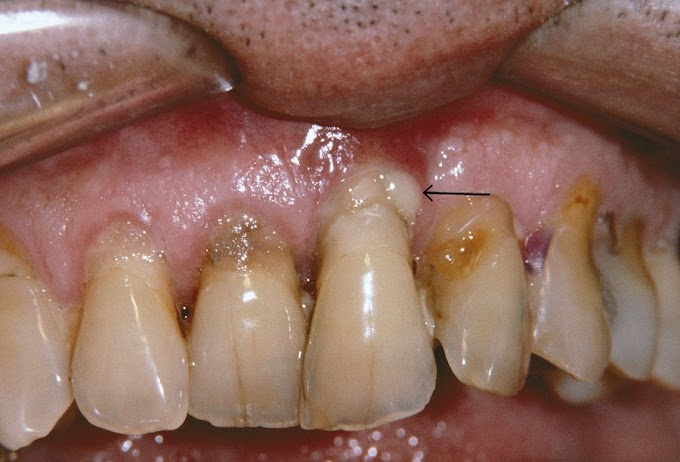 ENTREVISTA: ¿Es contagiosa la Periodontitis? - Dr. Cuevas