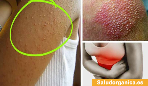 Sintomas de intolerancia al gluten en la piel