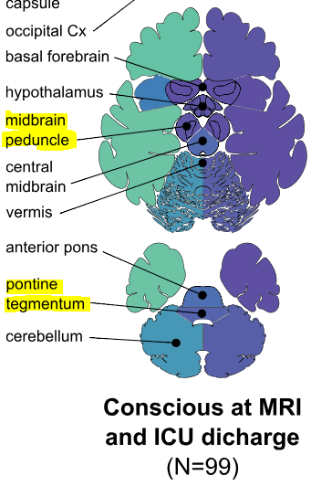 図：脳内出血　意識　脳構造