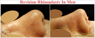 Revision Nose Job Surgery For Men in Istanbul - Revision Male Rhinoplasty in Istanbul - Men's Revision Rhinoplasty in Turkey - Revision Nose Reshaping For Men in Istanbul - Mens Revision Rhinoplasty in Istanbul - Revision Nose Job Rhinoplasty For Men in Istanbul - Best Revision Rhinoplasty For Men Istanbul - Revision Nose Aesthetic For Men in Istanbul - Male Revision Nose Operation in Istanbul - Male Revision Rhinoplasty Surgery in Istanbul - Male Revision Rhinoplasty Surgery in Turkey - Male Revision Nose Aesthetic Surgery in Istanbul - Revision Rhinoplasty In Mens Istanbul