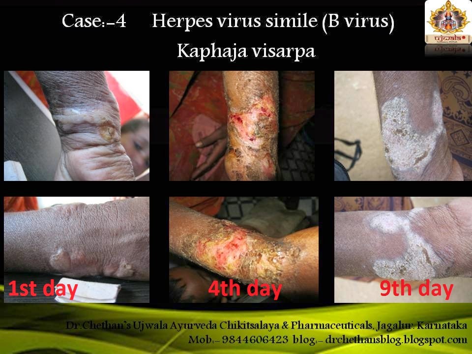 Dr.Chethan's Ayurvedic Remedies: Ayurvedic Medicine for sarpa suttu