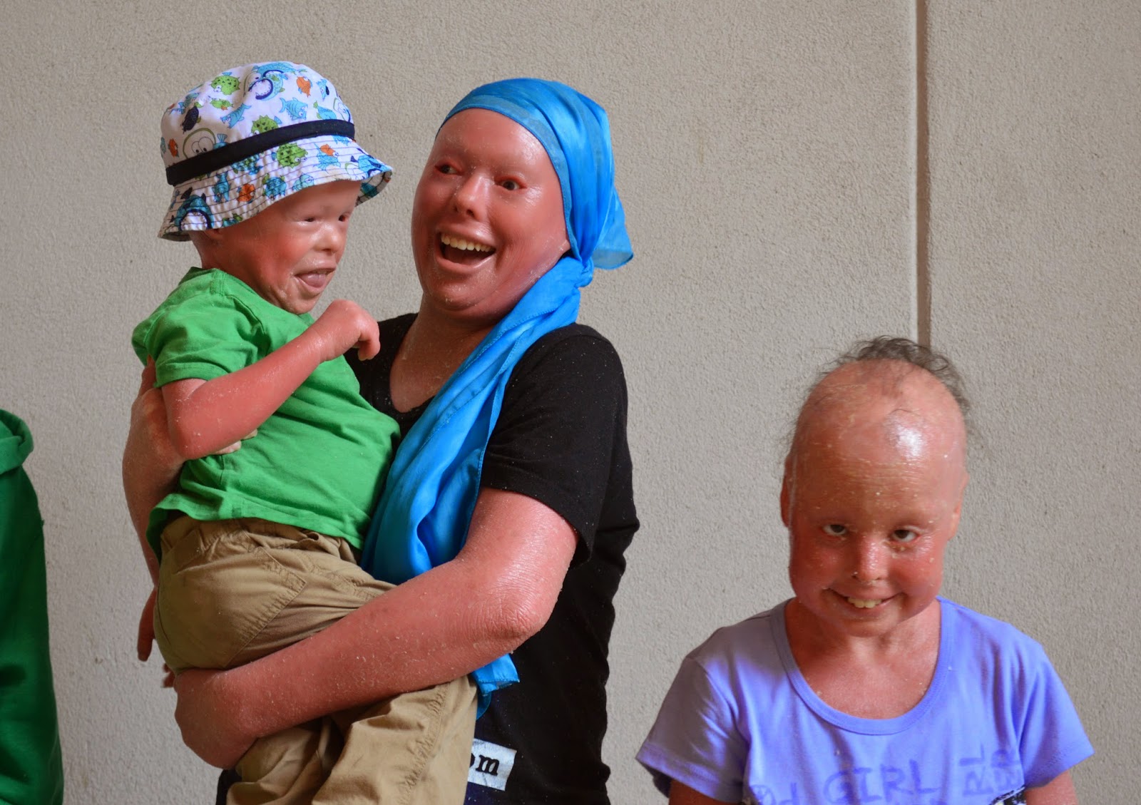 Harlequin Ichthyosis Survivor
