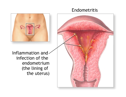 endometris
