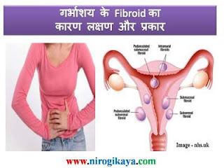 fibroid-causes-symptoms-types-in-hindi