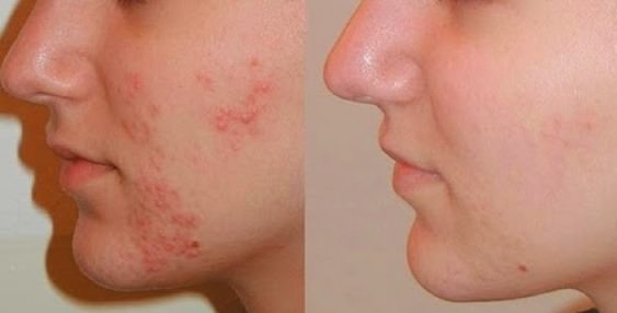 Como eliminar el acne naturalmente