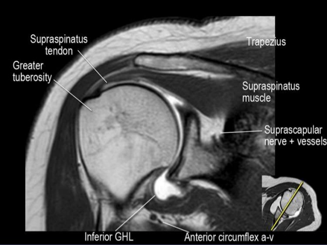 Mri Musculo Skeletal Section Mri Anatomy Of The Shoulder Coronal View