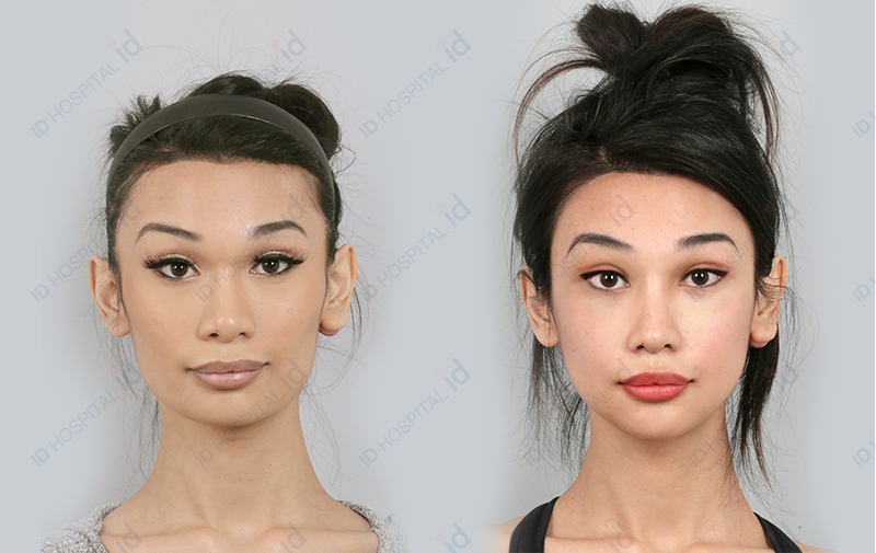 ID Hospital Korea Curious about the difference between double jaw