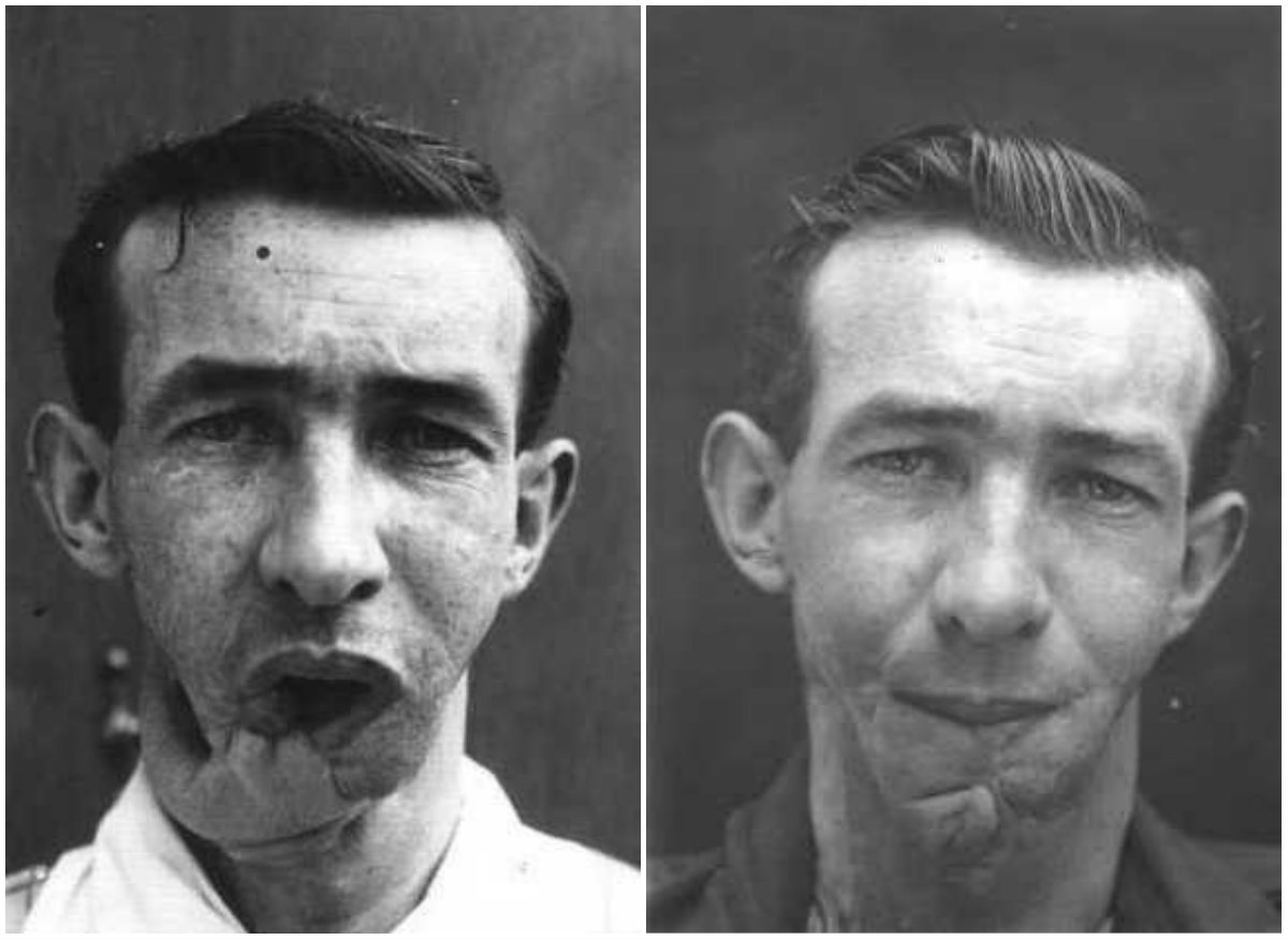 Faces From the Front Incredible Before and After Photos Show World War I Soldiers’ Horrific