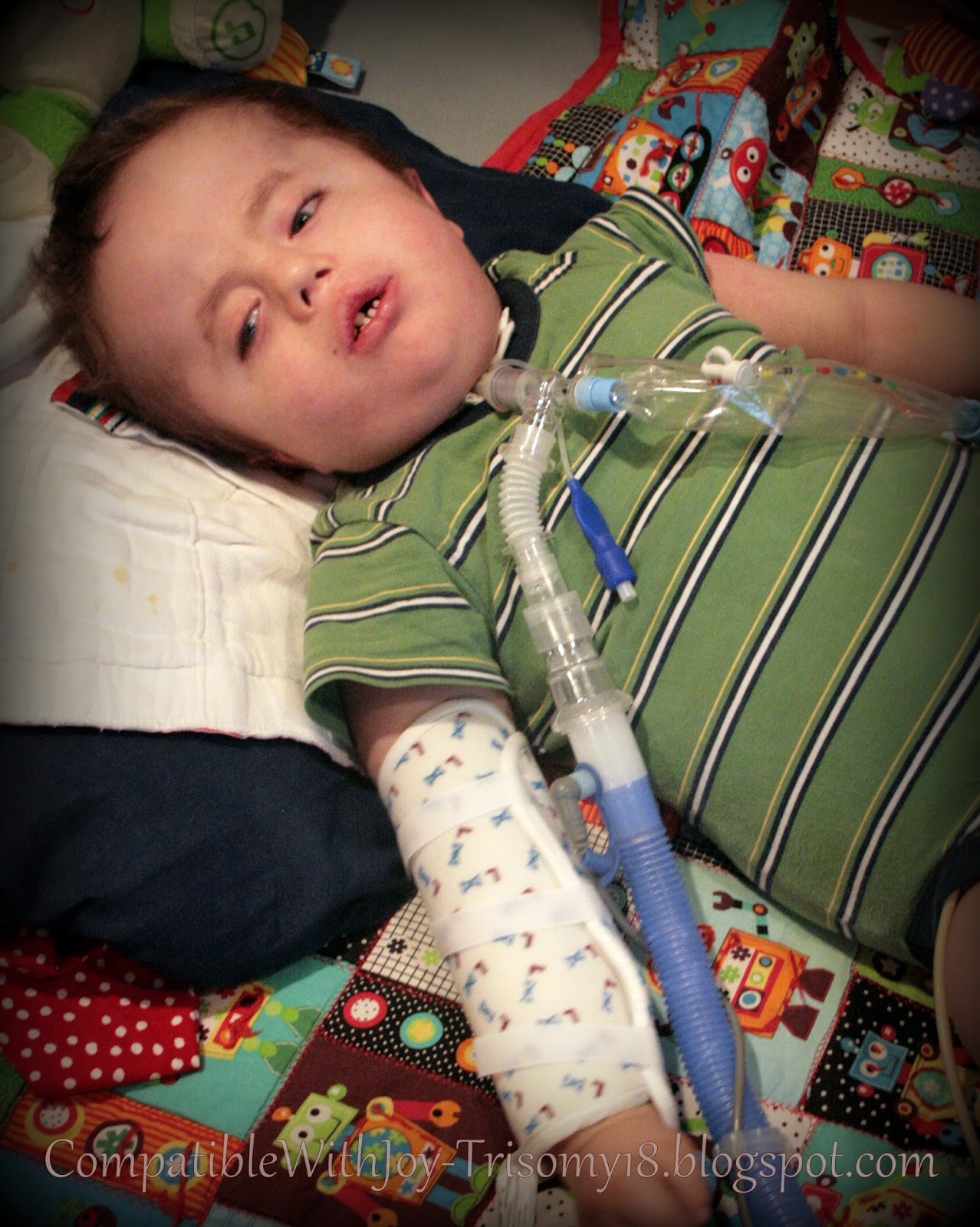 Compatible With Joy-Trisomy18: More Than One Way to Skin a Cat