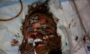 Kelly Thomas lying in a hospital bed badly injured