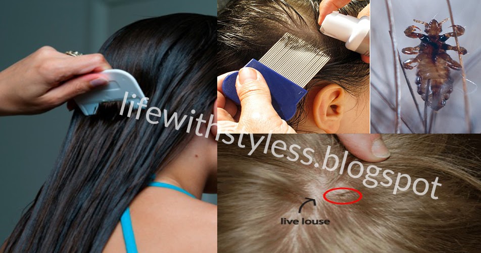 Best Way to Remove Head Lice Eggs In Just 15 Minutes Life With Styles