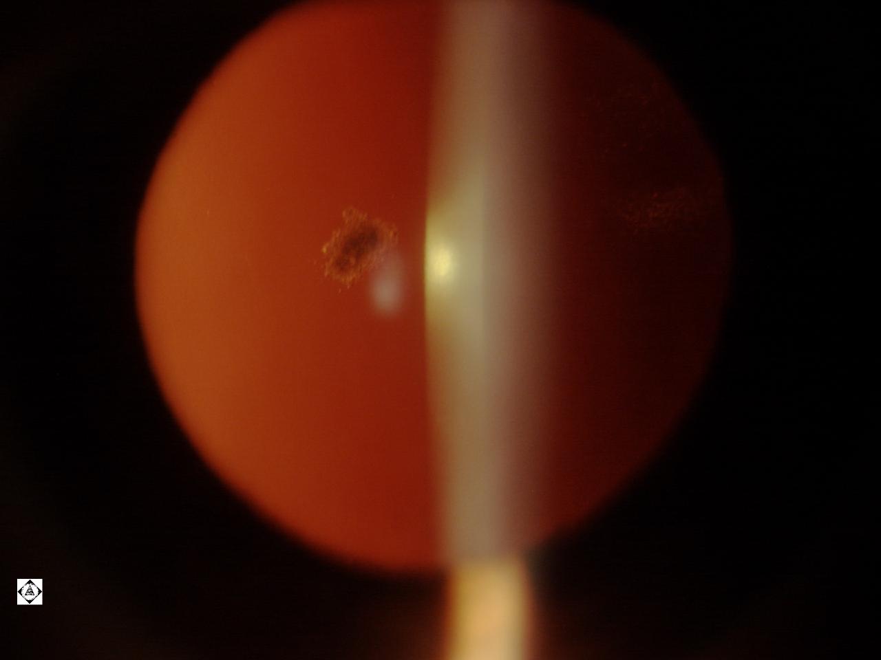 mittendorf-dot-sonoran-desert-eye-center