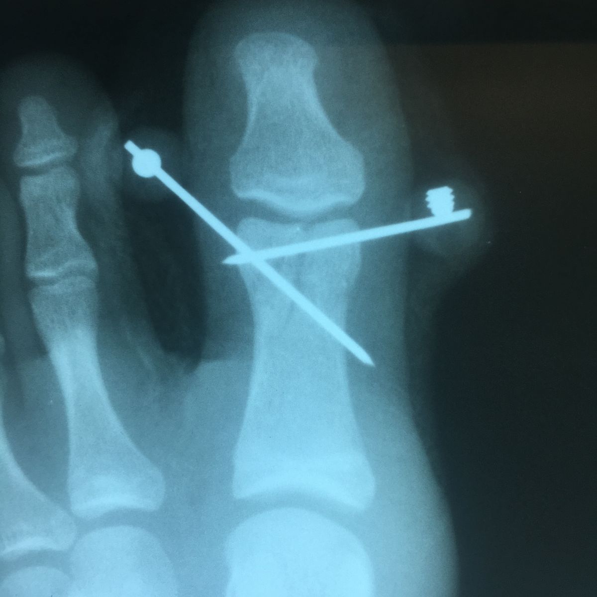 внутрисуставной оскольчатый перелом. метаэпифиза лучевой кости анатомия. метаэпифиза лучевой кости рентген. краевой внутрисуставной перелом головки лучевой кости. внутрисуставной перелом руки.