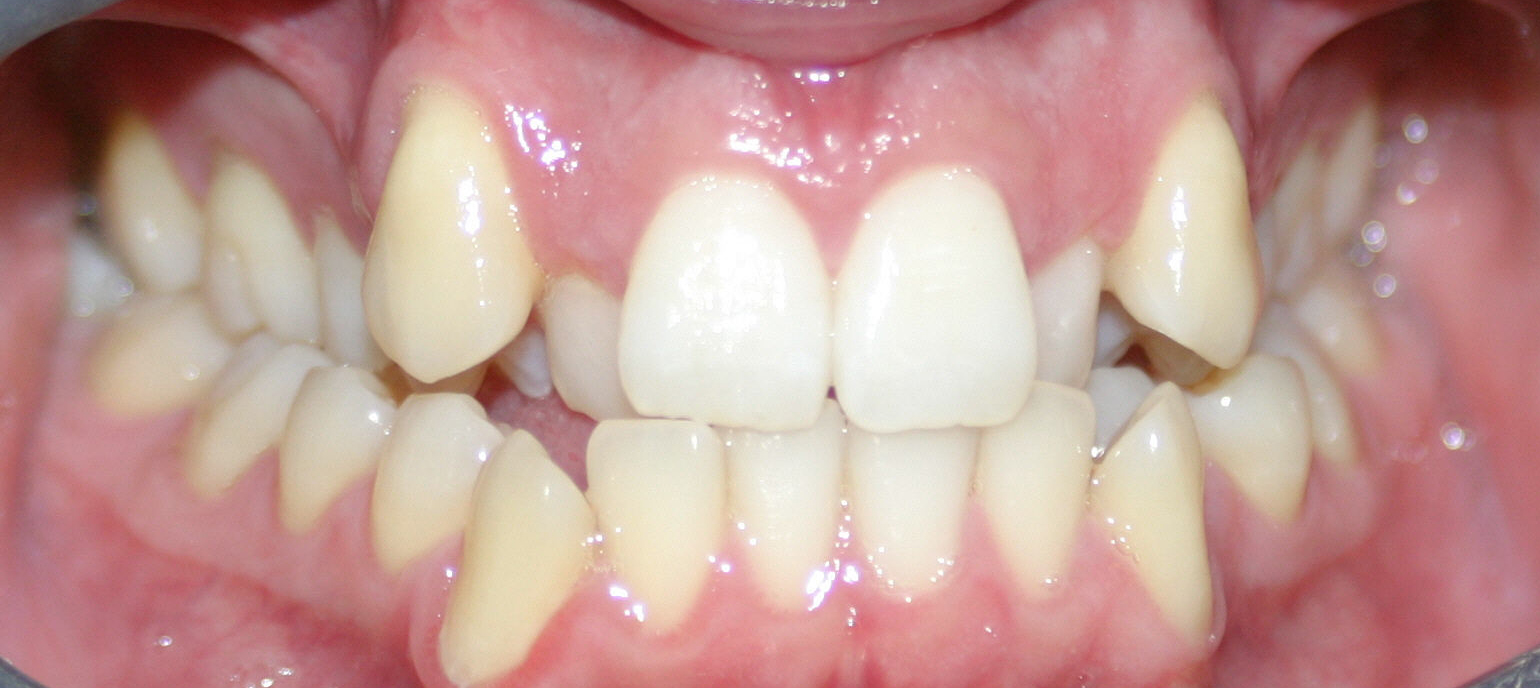 James R. Waters, DDS, MSD, PA Crowded teeth can lead to early tooth loss.