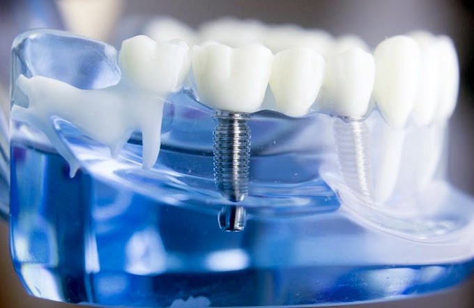 INTERVIEW: Discussing the role of technology with dental implants