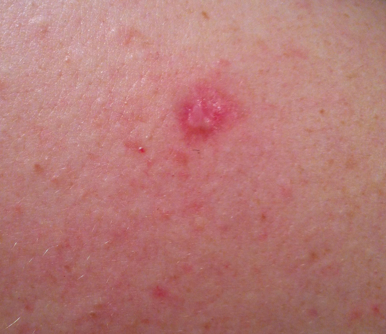 A Life Less Ordinary... Dermatology For Dummies In Treatment