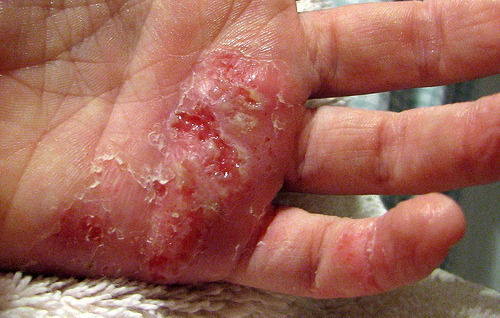 Ubat Untuk Merawat Eczema - Contoh L