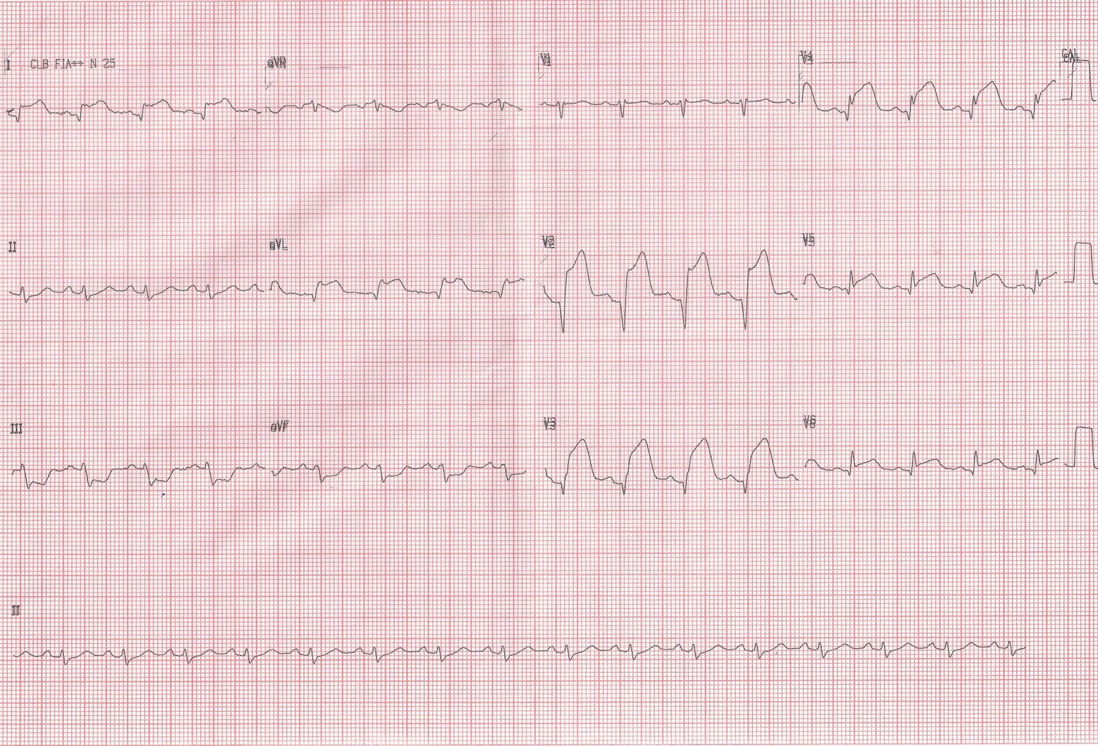 Blog de Eletrocardiografia COMO DIFERENCIAR SCA COM SUPRA DE ST DA REPOLARIZAÇÃO PRECOCE (E Blog de Eletrocardiografia COMO DIFERENCIAR SCA COM SUPRA DE ST DA REPOLARIZAÇÃO PRECOCE (E