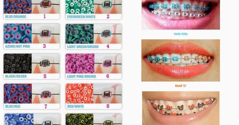 Get Fake Braces Atau Real Braces Desktop Wallpaper Wallpaper Fake Braces Atau Real Braces For Android