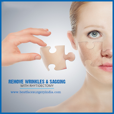 facelift surgery in delhi