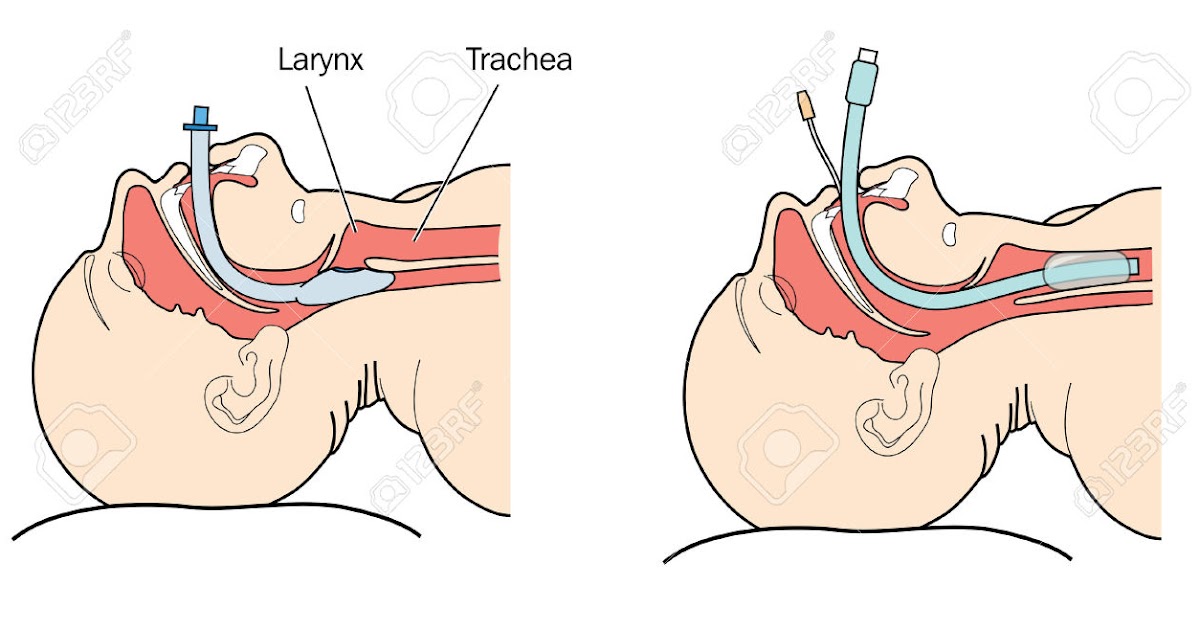 Teknik pemasangan ETT (endotracheal tube)