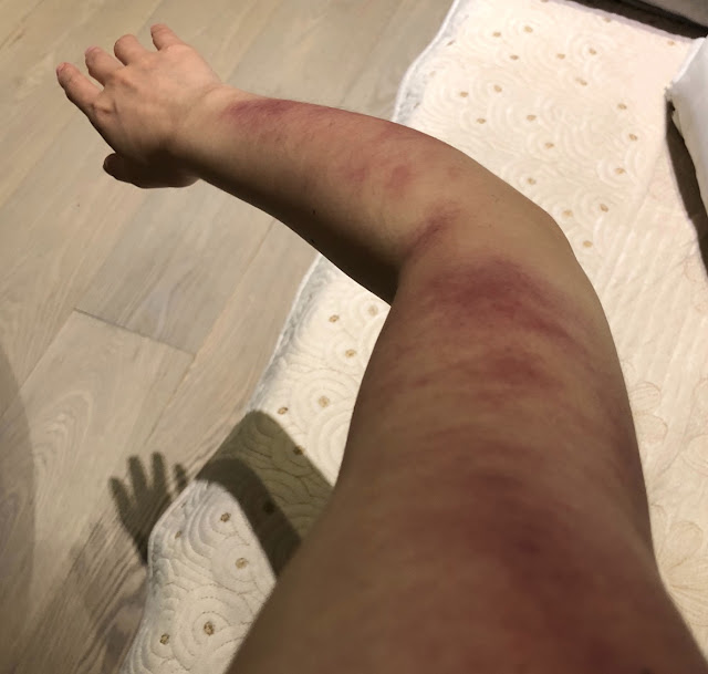 rainie yang bruised arm gua sha