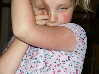 slap cheek virus in children