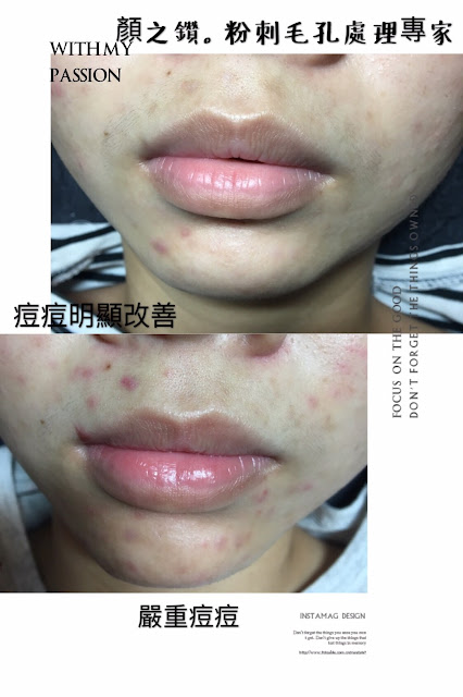 顏之鑽高雄美容做臉清粉刺除痘痘護膚SPA,奎蒂絲杏仁酸精華液, 高雄左營岩盤浴推薦, 高雄全身去角質推薦, 高雄美容沙龍推薦, 高雄美容SPA推薦, 高雄做臉清粉刺推薦, 高雄WAXXXX熱蠟除毛推薦, 顏之鑽高雄美容做臉清粉刺除痘痘護膚SPA,高雄左營美容店,左營美容SPA護膚, 高雄左營做臉,高雄左營做臉推薦,高雄左營做臉分享,高雄左營做臉評價,高雄左營做臉價格, 高雄左營清粉刺,高雄左營清粉刺推薦,高雄左營清粉刺店家,高雄左營清粉刺推薦店家,高雄左營清粉刺價格, 高雄左營清粉刺評價,高雄左營清粉刺分享,高雄左營清粉刺便宜,高雄左營無痛清粉刺,高雄左營擠粉刺, 高雄左營美顏店推薦,高雄左營美顏店家, 高雄左營美容店推薦, 高雄左營熱蠟除毛,高雄左營熱蠟除毛便宜,高雄左營熱蠟除毛分享,高雄左營熱蠟除毛評價,高雄左營熱蠟除毛價格, 高雄左營熱蠟除毛推薦,高雄左營蜜蠟除毛評價,高雄左營蜜蠟除毛便宜,高雄左營蜜蠟除毛價格,高雄左營蜜蠟除毛推薦, 高雄左營腋下除毛評價,高雄左營腋下除毛推薦,高雄左營腋下除毛價格,高雄左營腋下除毛分享,高雄左營腋下除毛便宜, 高雄左營私密處除毛評價,高雄左營私密處除毛推薦,高雄左營私密處除毛價格,高雄左營私密處除毛便宜, 高雄左營岩盤浴SPA,高雄左營岩盤浴,高雄左營岩盤浴推薦,岩盤浴高雄左營