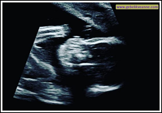 20 haftalık gebelik ultrason görüntüsü